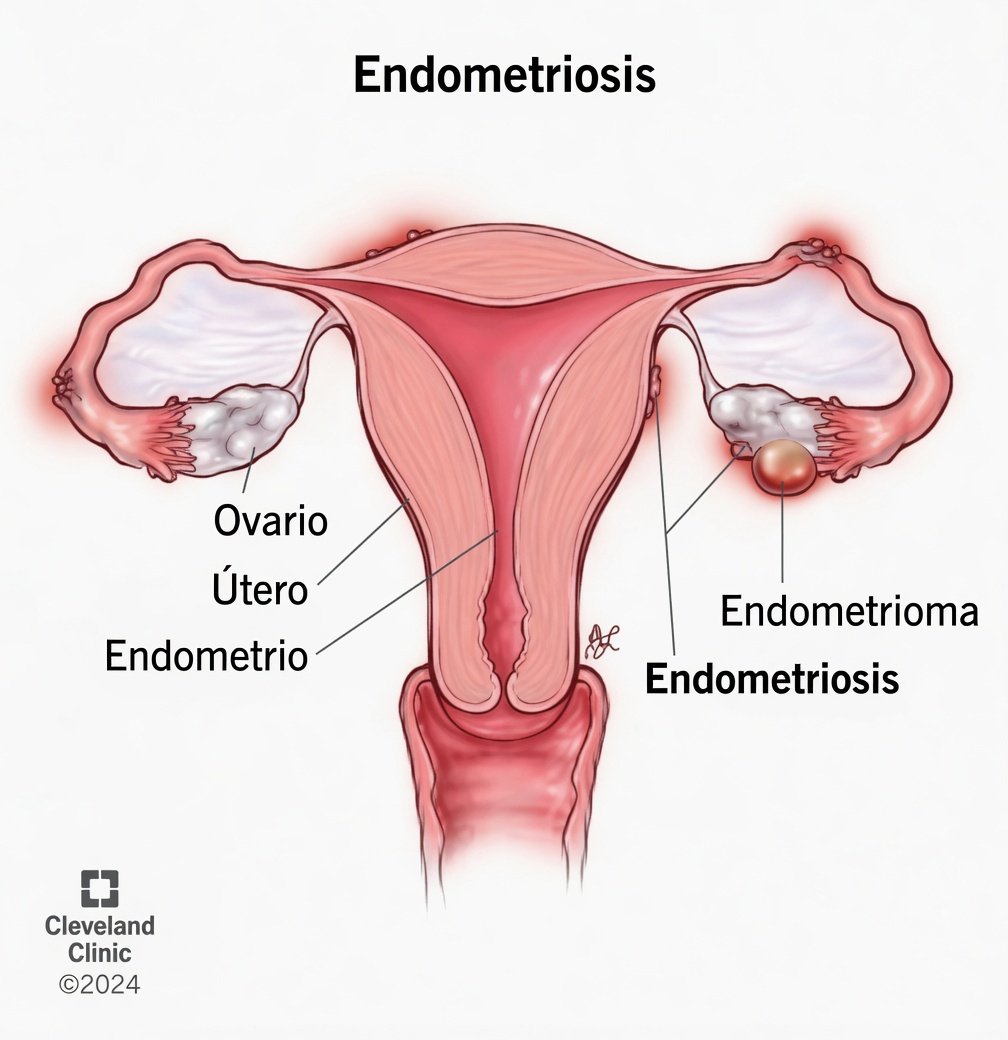 ¿Qué es la endometriosis y por qué toda mujer debería saber sobre ella?