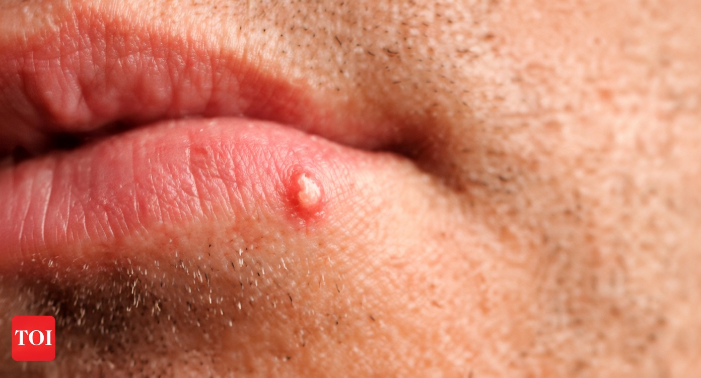 Por qué la gente nota pequeños bultos blancos inusuales en los labios o en sus partes íntimas: una guía sencilla