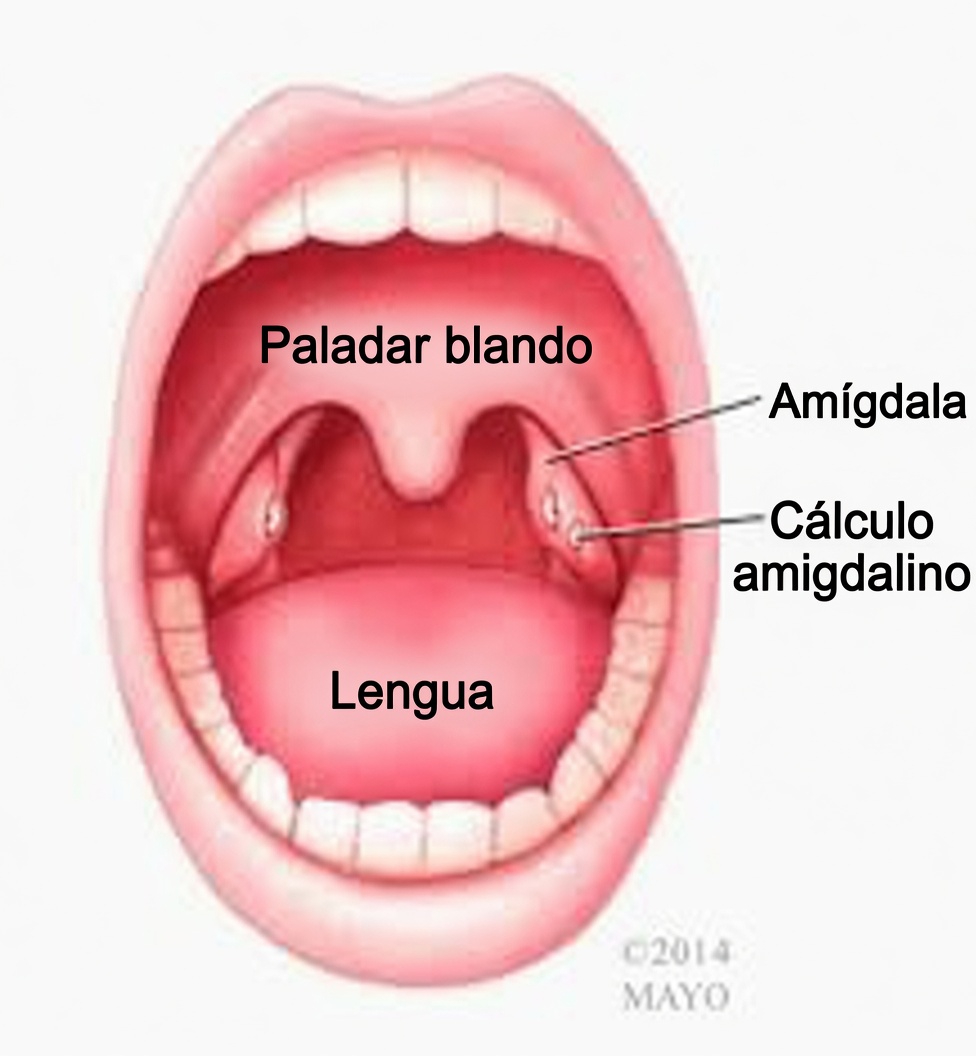 ¿Qué es ese pequeño bulto que salió de tu garganta después de estornudar? Entendiendo los cálculos amigdalinos