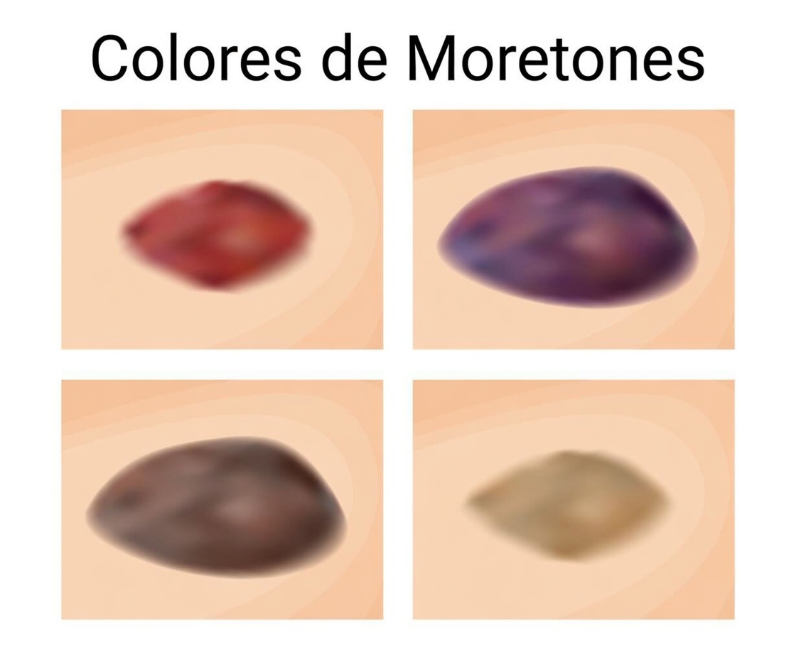 ¿Qué significa el color de tu moretón? Una advertencia que tu cuerpo podría estar enviando.