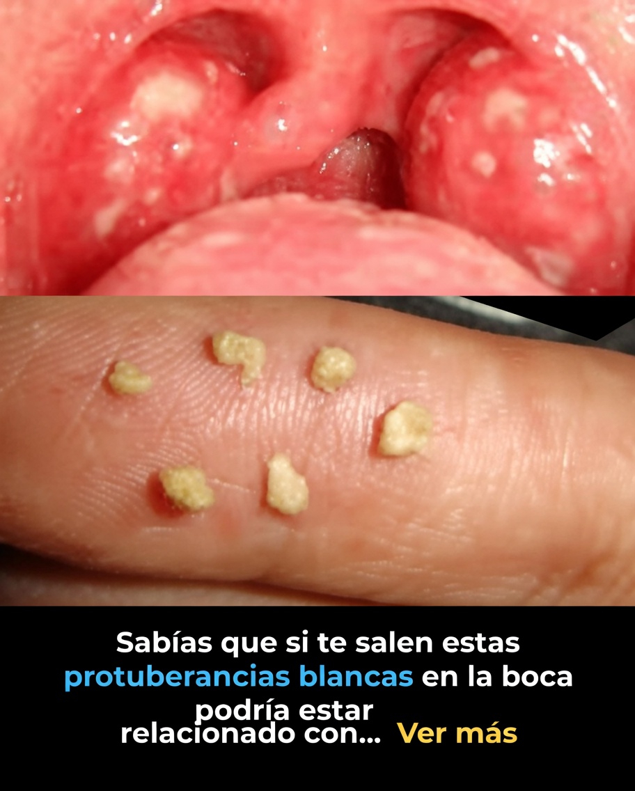 Descubre qué podrían significar esos bultos blancos en tu boca y los hábitos diarios que vale la pena probar