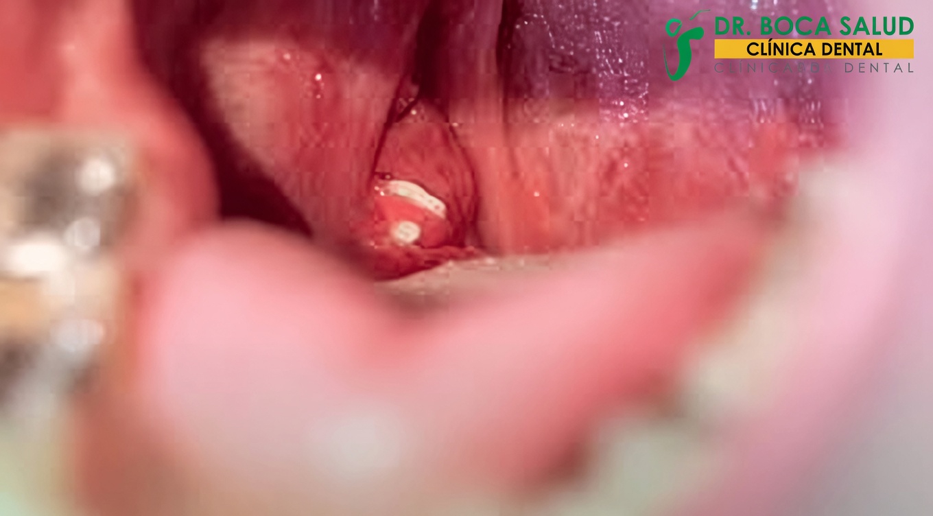 Cálculos amigdalinos: qué son y por qué podrían ser la causa de tu mal aliento persistente