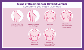 Síntomas del cáncer de mama más allá del bulto: señales menos conocidas que toda mujer debería reconocer