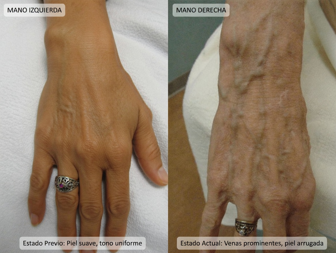 10 formas naturales de deshacerse de las várices y mejorar el flujo sanguíneo de forma natural