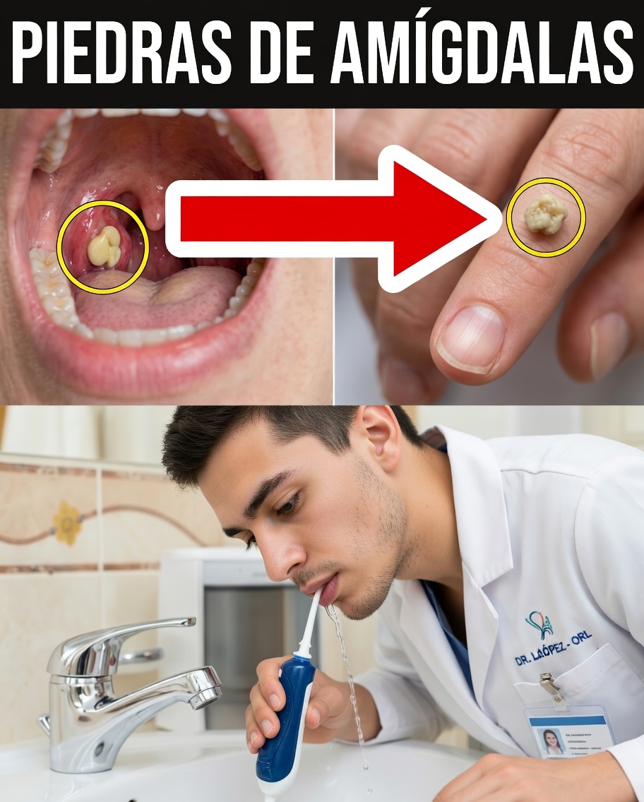 Los cálculos de las amígdalas al descubierto: la causa oculta del mal aliento y las molestias de garganta