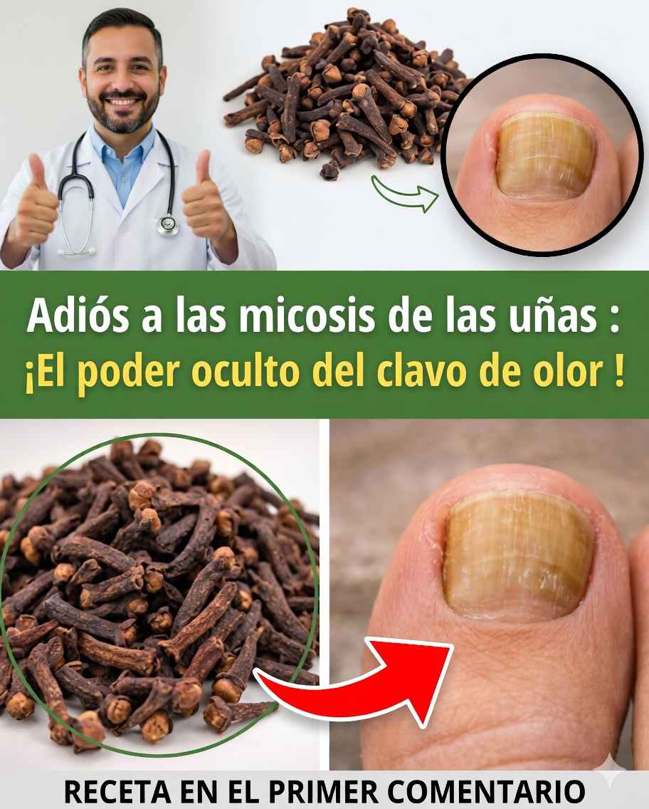 💅 Eliminar los hongos de las uñas con el clavo de olor: el remedio natural que muchos adoptan