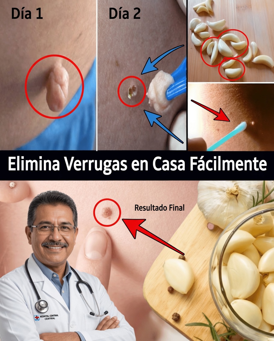 Cómo eliminar las verrugas cutáneas de forma natural con vaselina: un método sencillo de la noche a la mañana